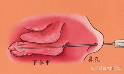 下鼻甲肥大怎么治疗