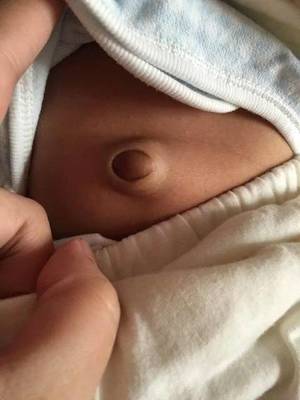 1岁宝宝肚脐突出照片