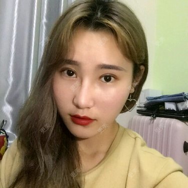 广西眼部整形
