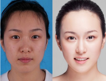 脸部吸脂费用是多少