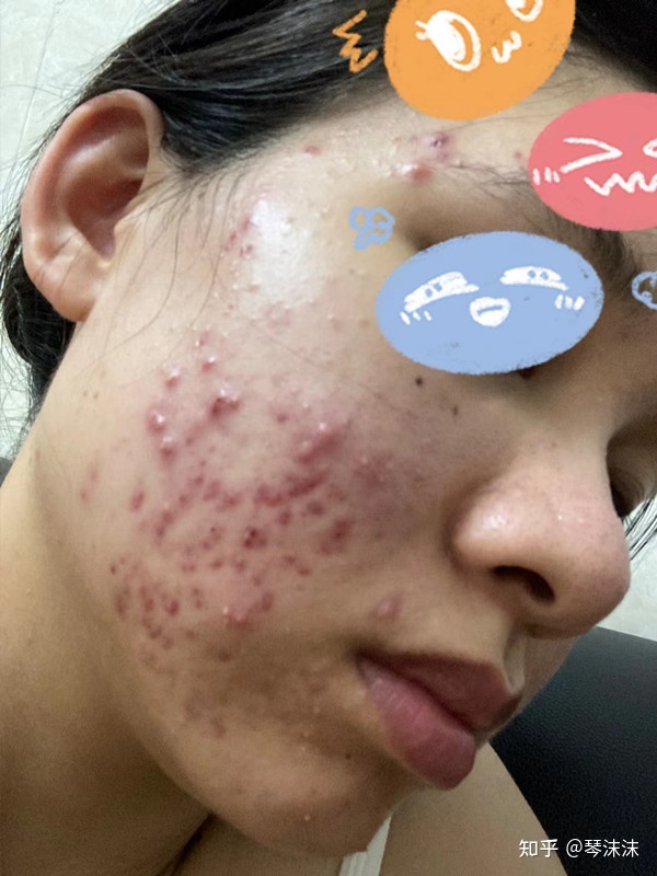 怎么才不长痘痘