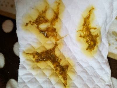 屎是白色的怎么回事