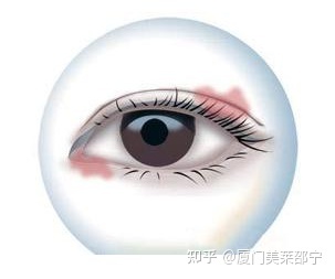 做完双眼皮水肿的原因