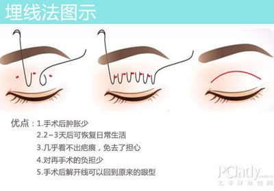 割双眼皮在哪里