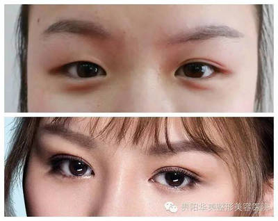好看的内眦双眼皮