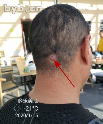 经络治痘痘