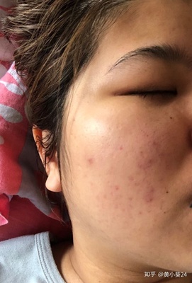 天气热脸上起痘痘