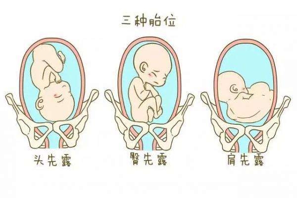 胎儿一直臀位说明宝宝有问题