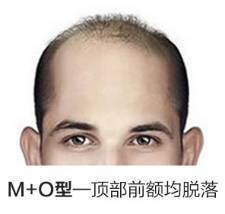 额头旋的人命运怎么样