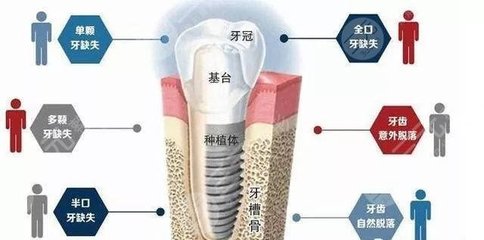 种牙的原理