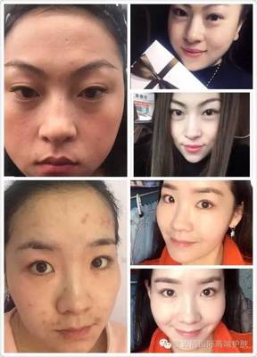 脸上有痘痘能打水光针吗