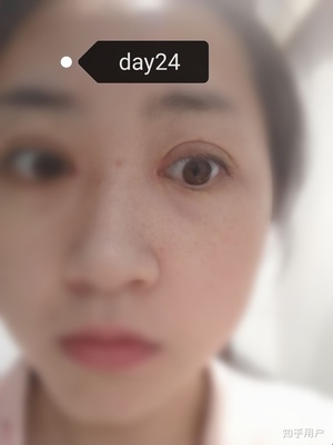 割双眼皮了能吃鸡蛋吗