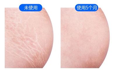 除疤痕的方法