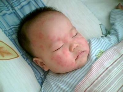 发痘痘忌口