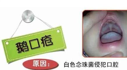 老起口疮是怎么回事