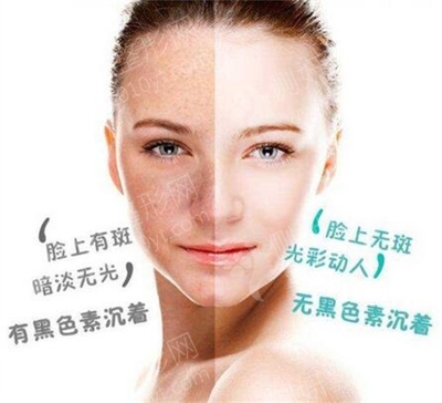 激光点痣 价格