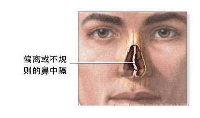 鼻中隔偏曲怎么治疗