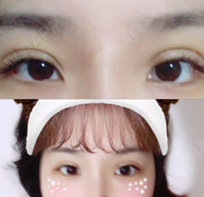 做了埋线双眼皮怎么消肿快