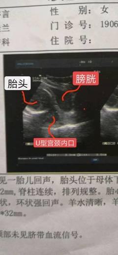 孕32周胎儿离宫颈口多少正常吗