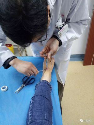 腱鞘囊肿脚上怎么治疗