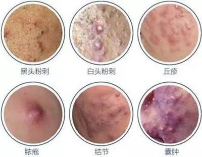 结节囊肿痘痘