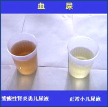 小便茶色是怎么回事