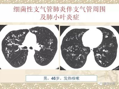 肺小结节会引起咳嗽吗