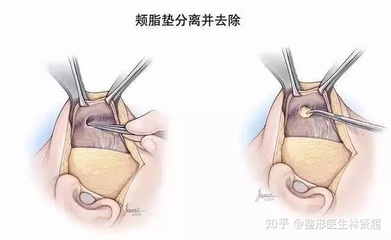 怀孕面瘫