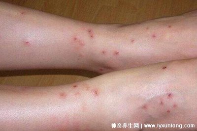 痘痘 伤口