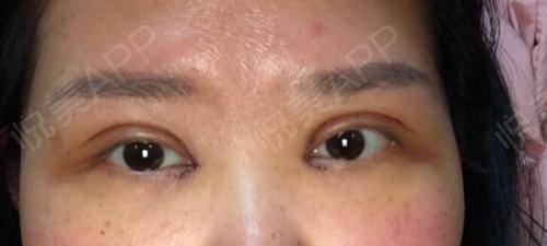 右眼皮肿是怎么回事
