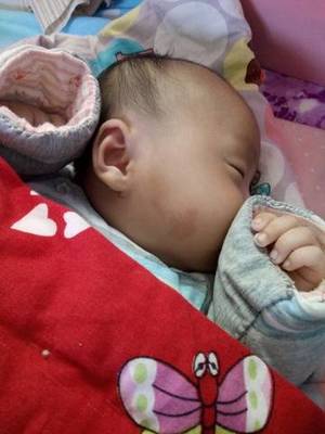 新生儿鲑鱼斑图片大全