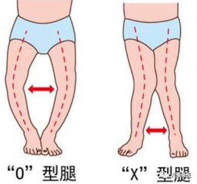 佝偻病怎么治疗效果好