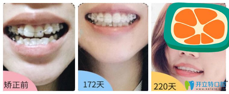 矫正牙齿前后