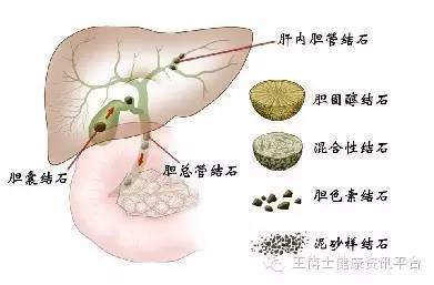 胆囊多发结石该怎么治疗