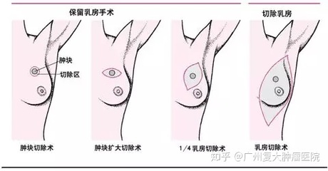 乳腺扩张是怎么回事