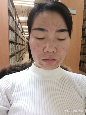 去美容院针清痘痘好吗