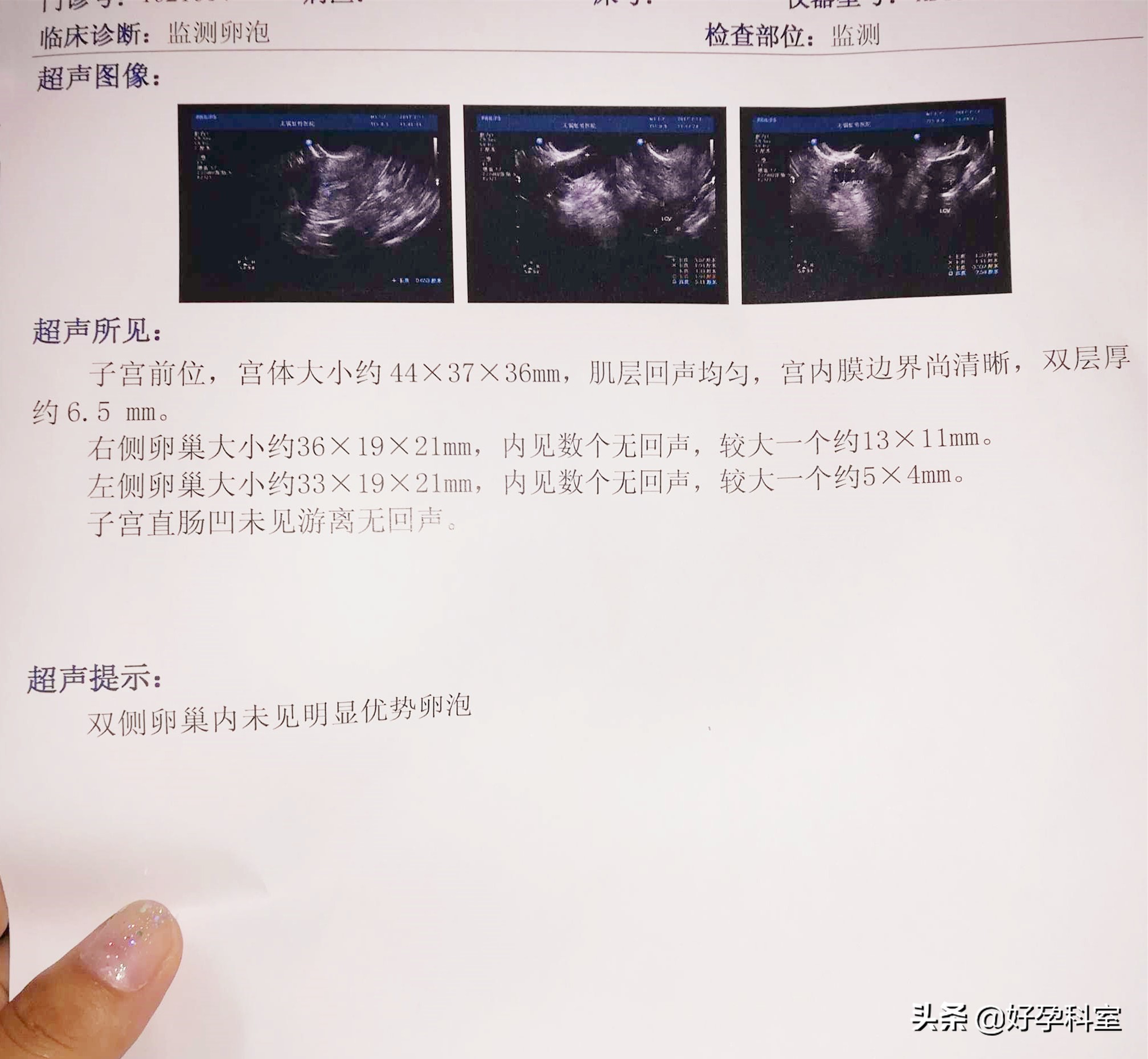 无优势卵泡竟然怀孕了