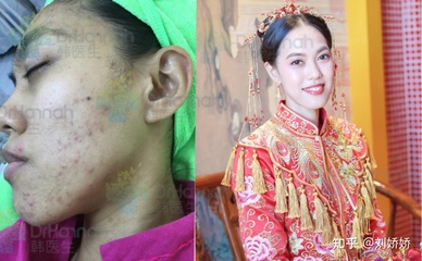 美容院能治好痘痘吗