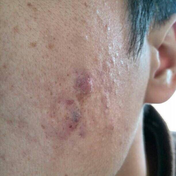 挤痘痘凸疤痕