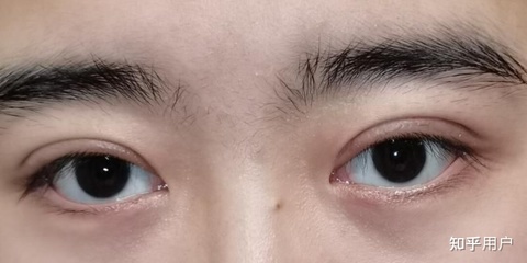 美莱做的双眼皮好吗