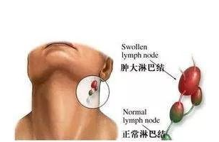 脖子两侧淋巴疼是怎么回事