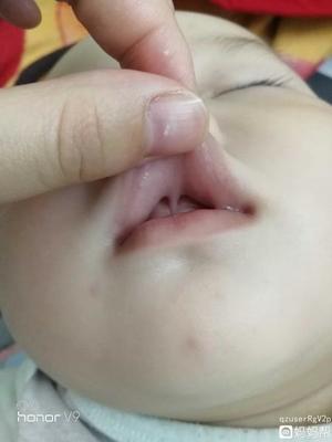 宝宝牙齿缝隙大怎么办