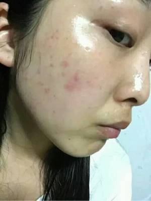 护肤品用了几天才过敏