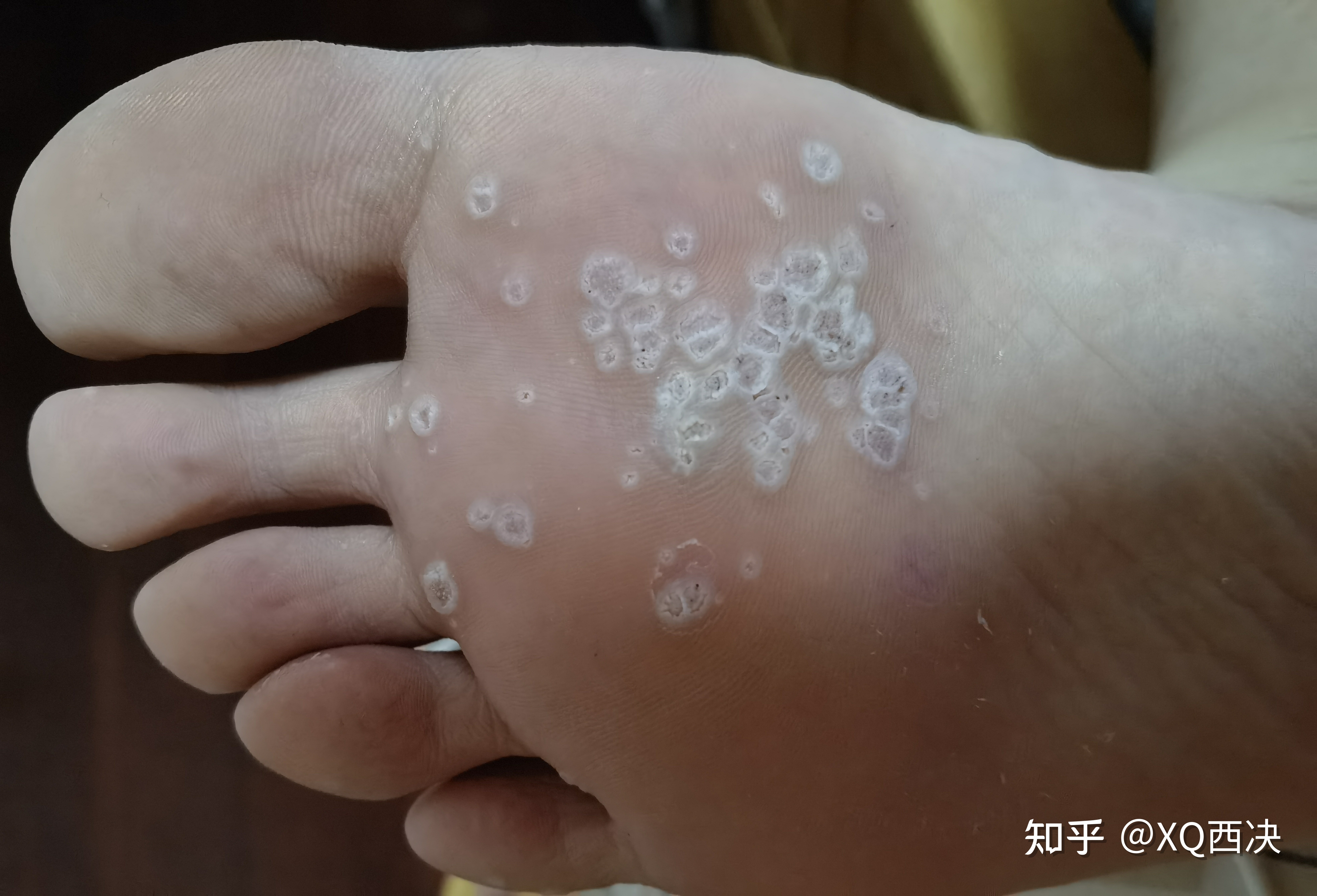 疣体一个月能长大多少