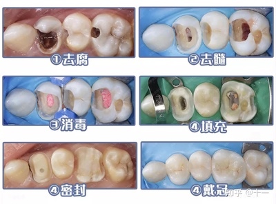 根管治疗怎么治