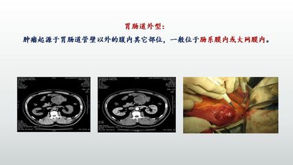 胃间质瘤是怎么回事