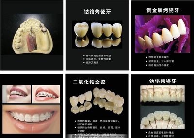 什么情况下做烤瓷牙