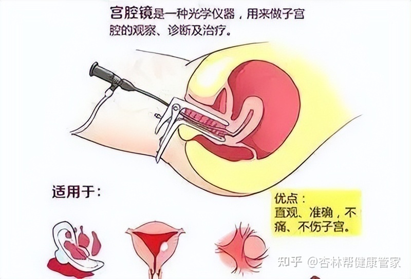 输卵管扩张是怎么回事