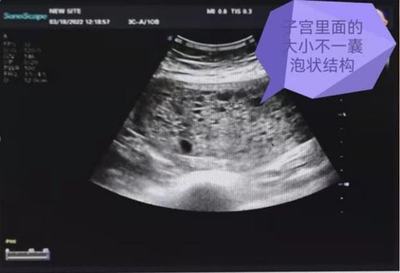 葡萄胎怀孕初期HCG多少