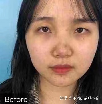 割了双眼皮后特后悔